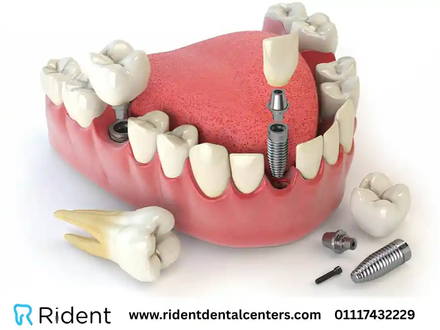 مدة زراعة الأسنان بعد الخلع في 3 حالات رئيسية